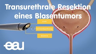 TURBT  Transurethrale Resektion eines Blasentumors [upl. by Aniri]