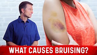 What Causes Bruising Without Trauma – Dr Berg [upl. by Eirual]