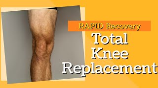 2 Key Exercises to Rapid Recovery for Total Knee Replacement [upl. by Gerdeen]