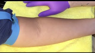 Tips For Locating Difficult Veins [upl. by Rana475]