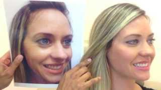 Botox amp Restylane Before amp After [upl. by Ardene]